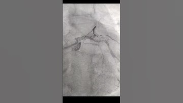 " Nail the ostium technique " in Primary Angioplasty to ostium LAD.
