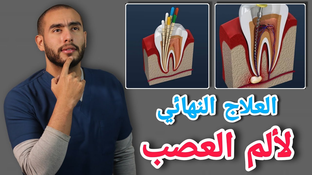 علاج الم الاسنان وحشو العصب | التهاب العصب الأسباب والعلاج | علاج الم العصب