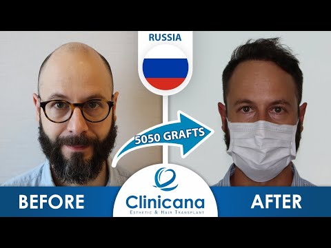 Alexey’s hair transplant