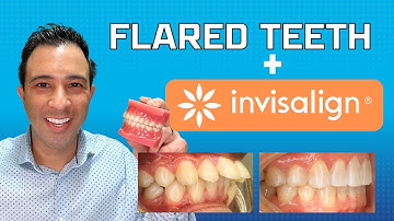 Invisalign Magic to Fix Flared Teeth WITHOUT EXTRACTION by Dr. Robert Passamano