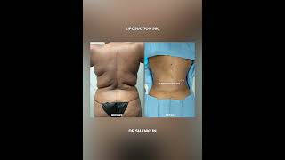 Breast lift with Lipo 360 by Dr Shanklin #smartplasticsurgery #miamisurgery #beforeandafter #miami