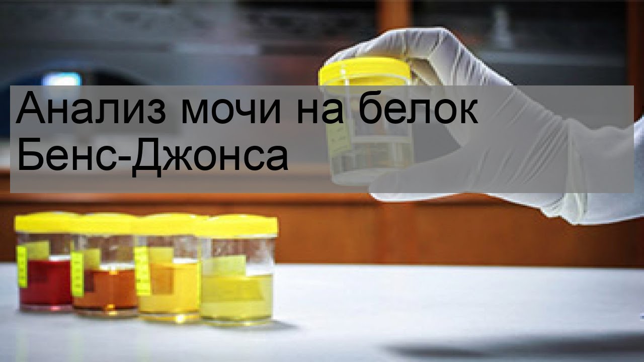 Анализ мочи на белок Бенс-Джонса