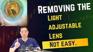 Intraocular lens exchange: A Trilogy. Episode 1 of 3: Light adjustable lens removal is a bitch.