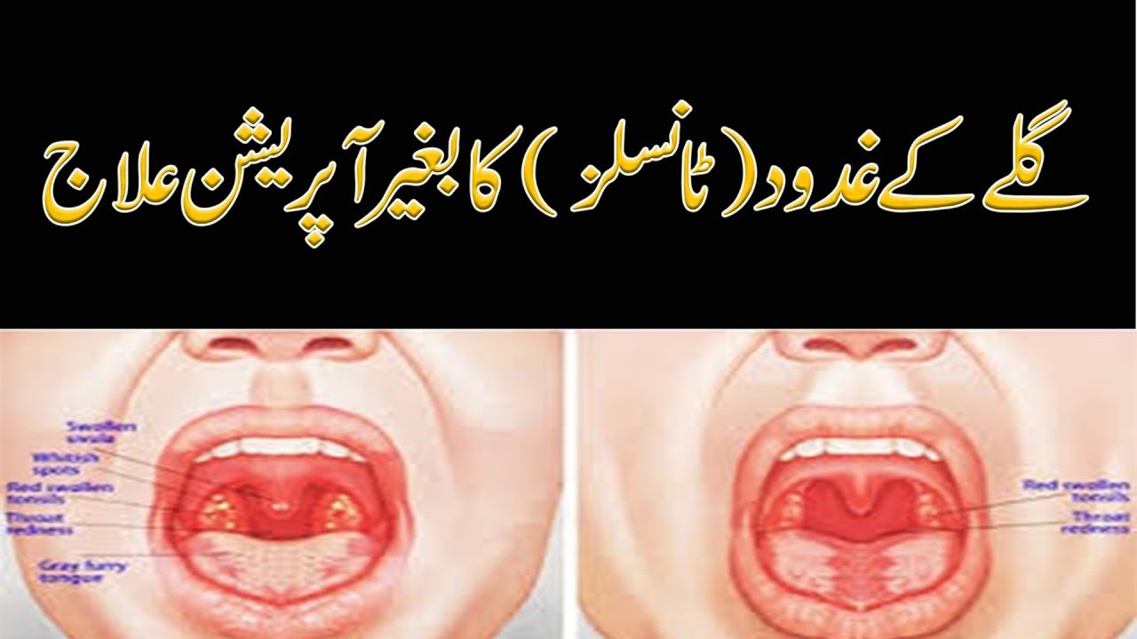 Homeopathic Treatment For Tonsils By Dr Naveed  Tonsil Ka 