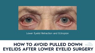 The Most Common Causes of Eyelid Retraction after Lower Eyelid Surgery, and How to Avoid Them