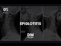 EPIGLOTITIS - ENARM