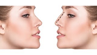 Моделирование носа | Как выбрать форму носа? | Ринопластика