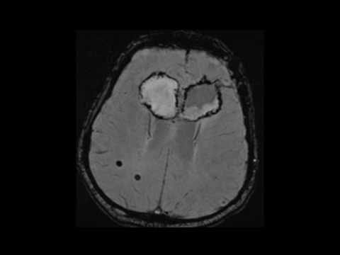 Video: Validasi Klinis Dan Penilaian Hemodinamik Aorta Menggunakan Simulasi Dinamika Cairan Komputasi Dari Computed Tomography Angiography