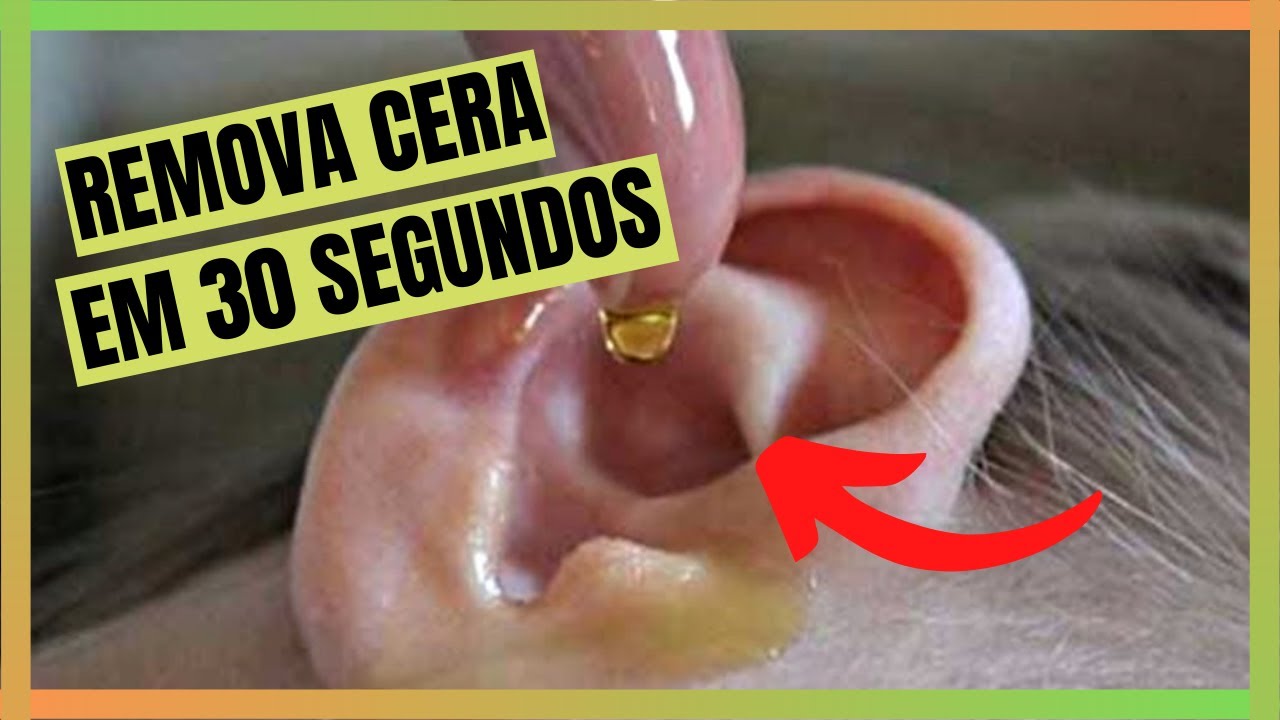 Aprenda Agora Como REMOVER CERA DO OUVIDO em 30 Segundos e Volte a ...