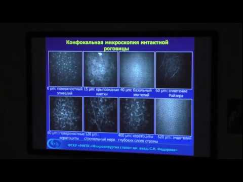 Изменения роговицы при длительном ношения контактных линз