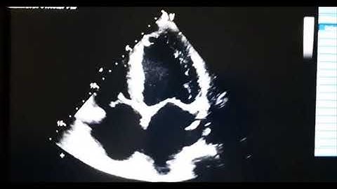 HEART&TECHY-MAPSE  and  TAPSE in echocardiography