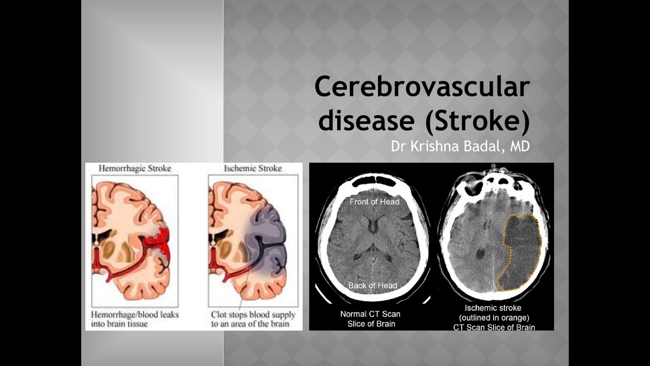 Cerebrovascular diseases YouTube
