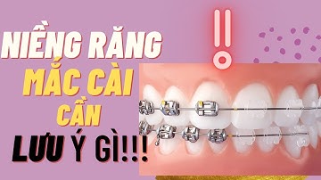 Gắn Mắc Cài Cần Lưu Ý Những Gì| Nha Khoa Minh Châu