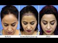 Female Hair Transplant Clinic in Mumbai, | Before and After Result | @Eugenix Hair Sciences