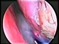 Cirugía de Cornetes (Turbinectomia con Laser)