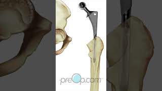 Total Hip Replacement Patient Education shorts