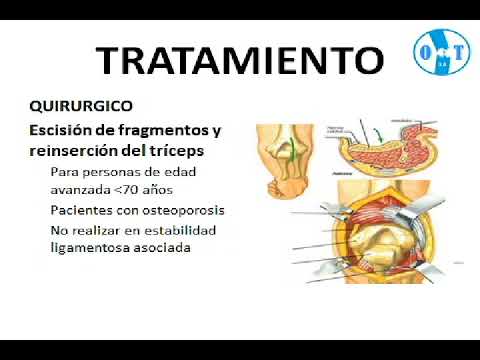 Vídeo: Fractura Del Olécranon Del Cúbito