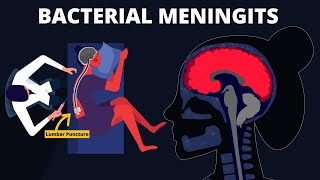 Bacterial Meningitis : Symptoms, Diagnosis, Treatments & Pathology