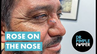 Dr Pimple Popper Opens A Rose on the Nose