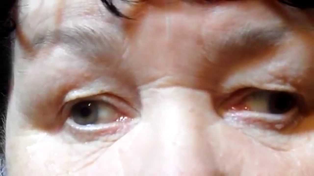 Ишемическая правосторонняя межъядерная офтальмоплегия. - YouTube