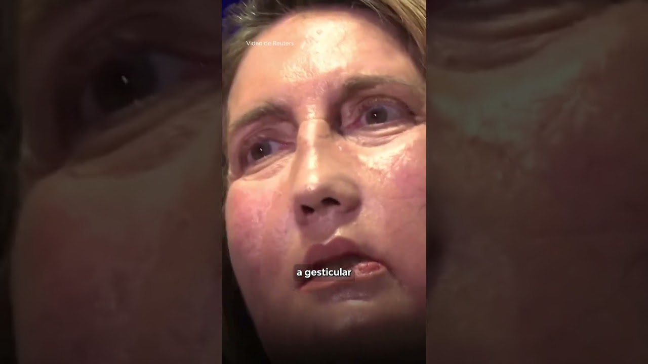Histórico trasplante facial en España | 24 Horas TVN Chile