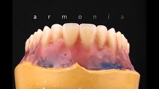 Molares superiores 17 y 27. Parte 10
