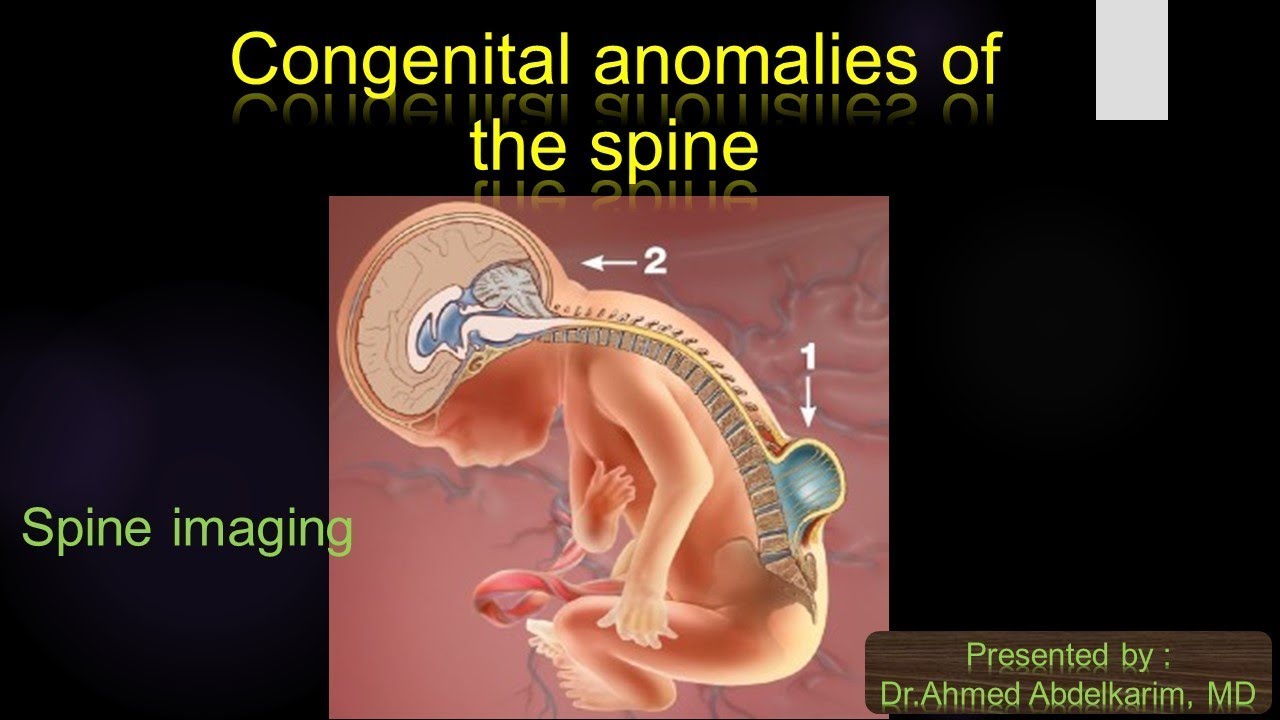 2 Congenital Anomaly Of The Spine I YouTube 2-congenital-anomaly-of-the-spine-i-youtube