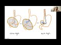 Eus guided pfc drainagetechnical tips on plastic stent placement by dr pramod gard eus masterclass