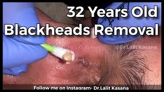 35 YEARS OLD DEEP BLACKHEAD REMOVAL BY DR.LALIT KASANA / NEW BLACKHEAD VIDEO