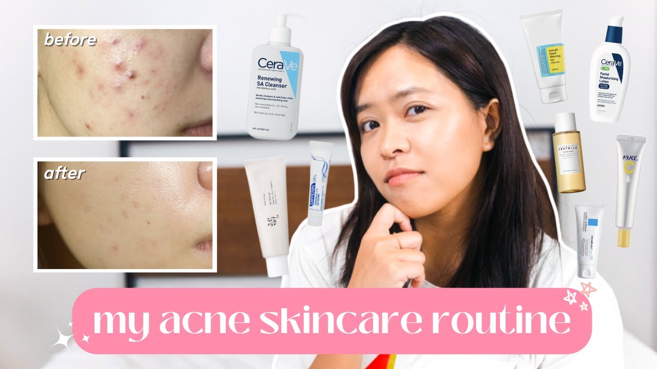 skincare series | am & pm acne fighting skincare routine | journey & tips