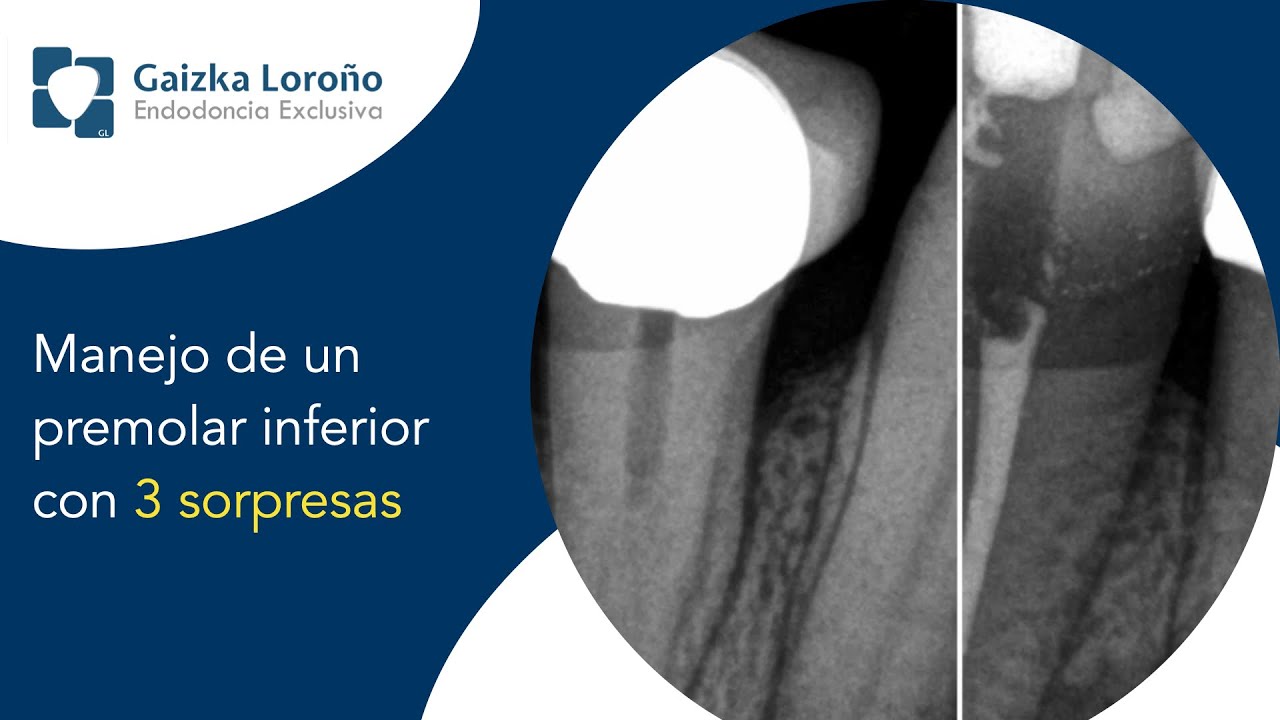 Manejo de un premolar inferior con 3 sorpresas