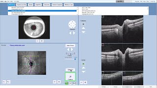 How to take an ONH scan on the ZEISS CIRRUS 6000