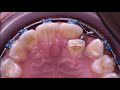 Double wire technique in orthodontic piggy back, correcting cross bite