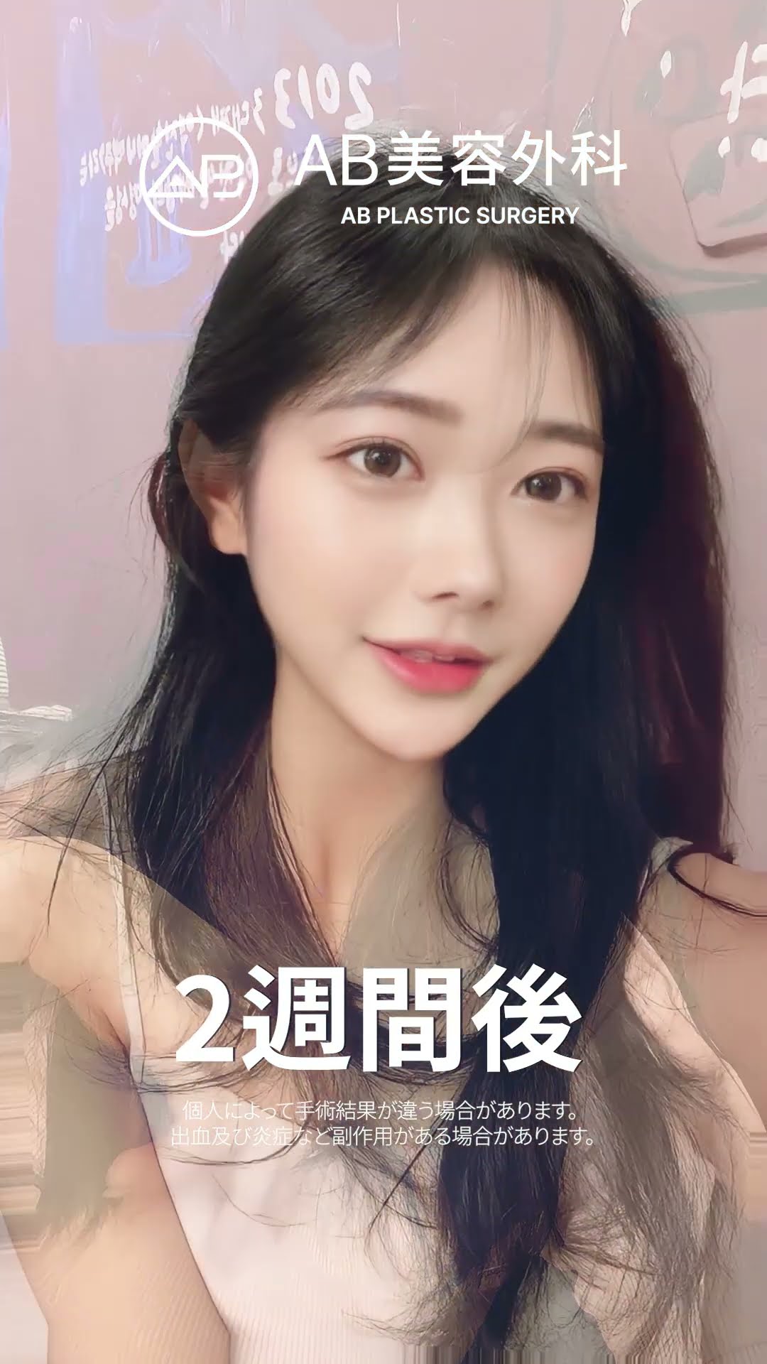 劇的変化！目と輪郭の整形結果を公開中！ #韓国整形 #美容