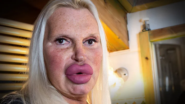 Surgery Obsessive Spends $76,000 In Quest For Perf...