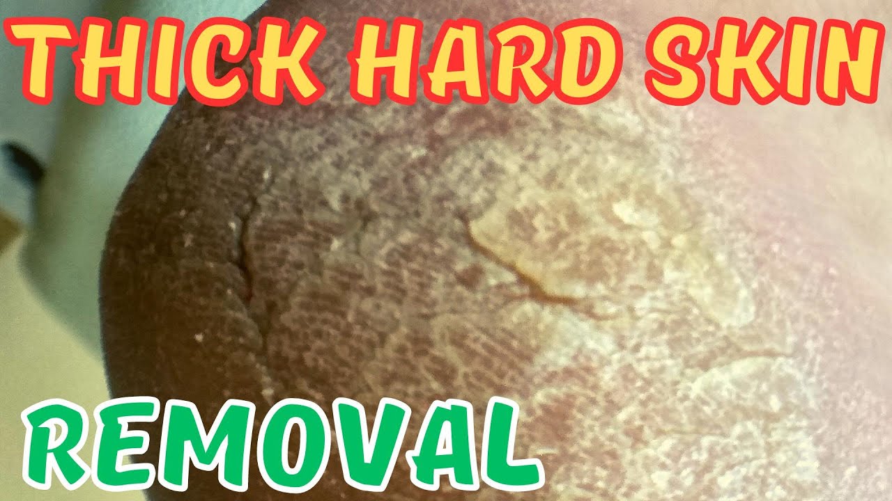 Thick dead skin satisfying removal from feet. Corns. YouTube