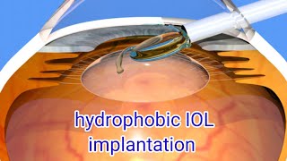 implantation of hydrophobic & Aspheric posterior chamber IOL