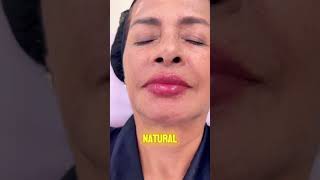 VOLIPS - VOLNEWMER + HYDRALIPS By Dra. Beauty  #medicinaesteticamedellin #skincare #belleza #beauty