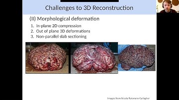 Feindel Virtual Brain and Mind Seminar at The Neuro presents Thomas Funck