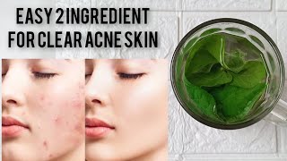 how to clear acne skin naturally at home