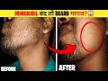 Beard आकर गायब क्यों हो गई? Minoxidil का काला सच! minoxidil beard growth scam | beard growth tips |