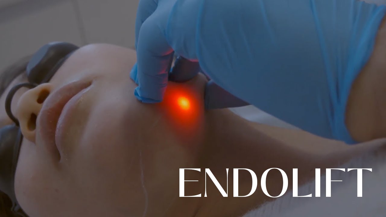 Endolift Process ENDOLIFT: The Non-Surgical Facelift - YouTube