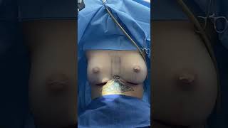 Cirugía implante de senos. No sangrado Dr Gabriel Peralta Mantilla