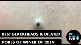 Best Of Blackheads and Dilated Pores of Winer for 2019