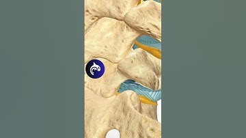 Lumbar Microdiscectomy of the Spine - See How It Works - 3D Animation #4k #backpain #chronicpain