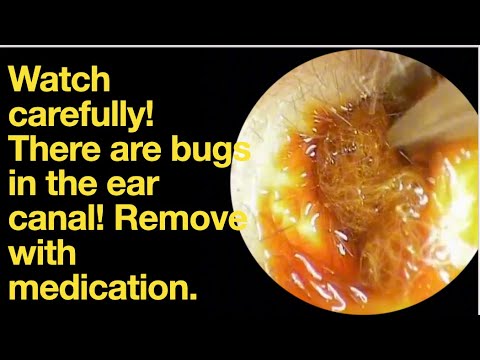 Watch carefully! There are bugs in the ear canal! Remove with ...