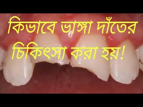 ভিডিও: দাঁতের আপনার ভয় কীভাবে কাটিয়ে উঠবেন