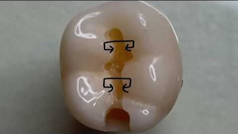 2023 ADEX Dental Exam - 30 seconds Molar CLASS II REVIEW