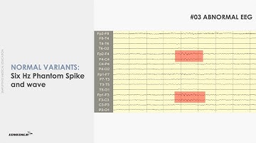 NORMAL VARIANTS ON EEG - [LEARN ADULT EEG]