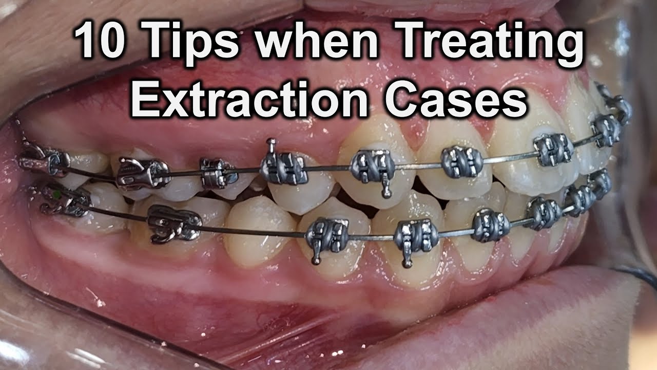 10 Tips when Treating Extraction Cases YouTube